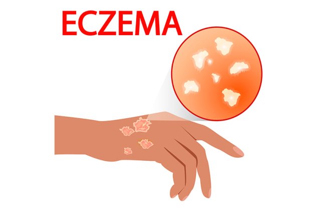 eczema skin, treatment, disease, pain, allergy, dermatology eczema skin, treatment, disease, pain, allergy, dermatology