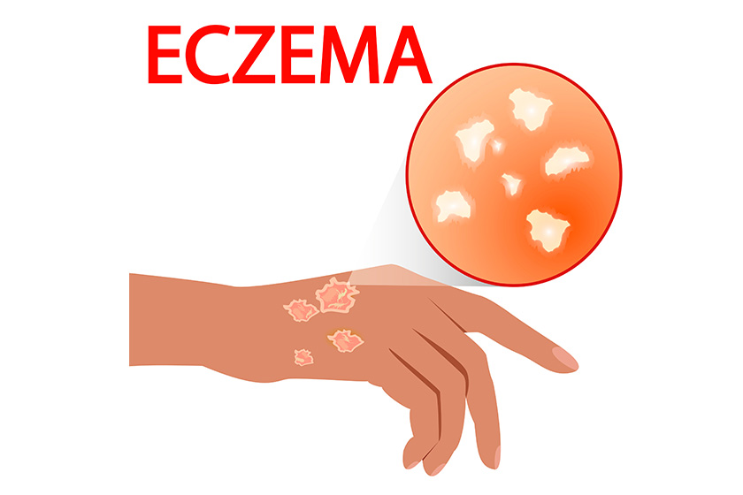 eczema skin, treatment, disease, pain, allergy, dermatology eczema skin, treatment, disease, pain, allergy, dermatology
