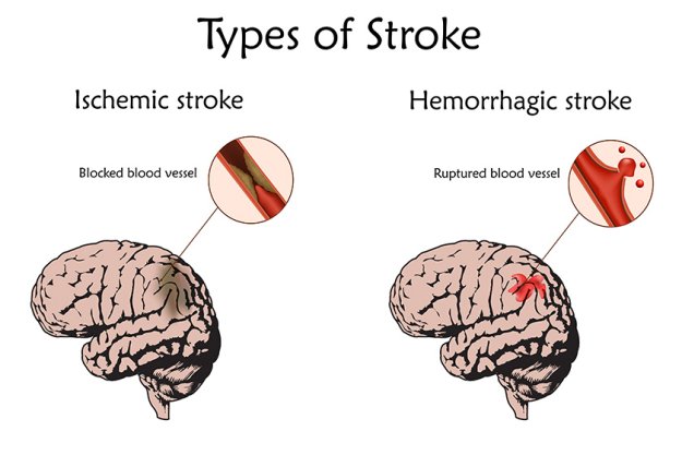 Stoke types poster, banner. Hemorrhagic, ischemic Stoke types poster, banner. Hemorrhagic, ischemic