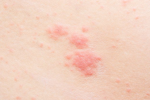 Providing Relief: How Assisted Living Facilities In Bluff View, TX Address Dermatitis Providing Relief: How Assisted Living Facilities In Bluff View, TX Address Dermatitis