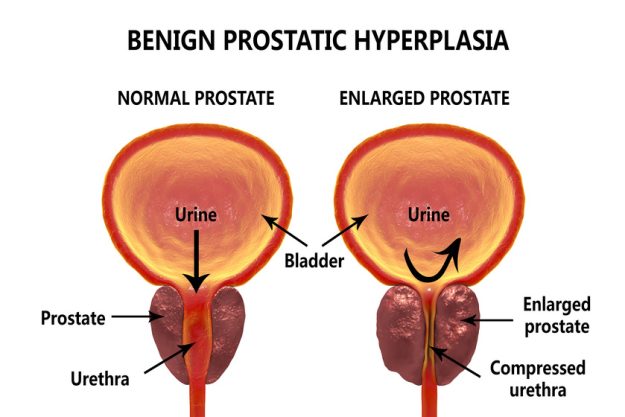 Benign prostatic hyperplasia How Assisted Living Facilities In Fort Worth, TX Care For Seniors With Prostate Issues