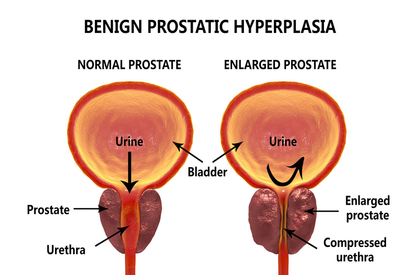 Benign prostatic hyperplasia How Assisted Living Facilities In Fort Worth, TX Care For Seniors With Prostate Issues
