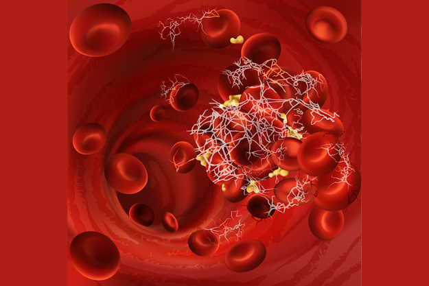 blood-clot-thrombus-embolus-coagulated-red-blood-cells blood-clot-thrombus-embolus-coagulated-red-blood-cells
